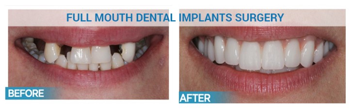 full mouth dental implants in India