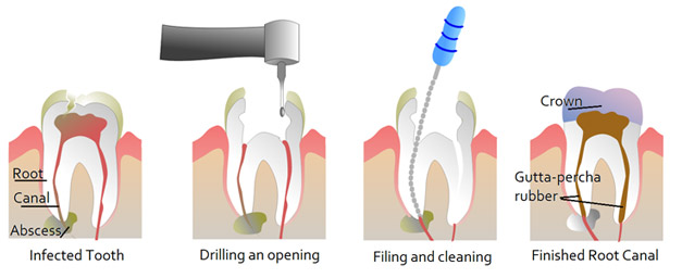 root canal therapy in new delhi, india