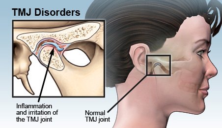 Temporomandibular Joint Disorder Cure Delhi