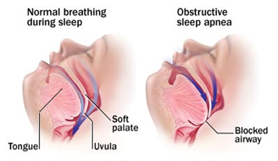 Obstructive Sleeping Apnea treatment in Delhi
