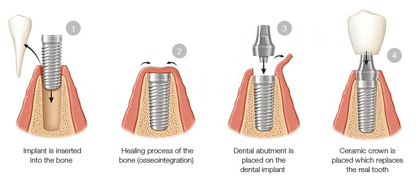 dental implants in new delhi, India 